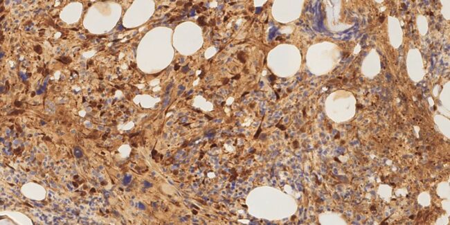 24.10.22 – cancer de sangre